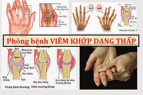 Những dấu hiệu, triệu chứng bệnh viêm đa khớp dạng thấp – Đông Y Bách Phúc  Thảo